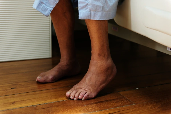 arthritis-treatment